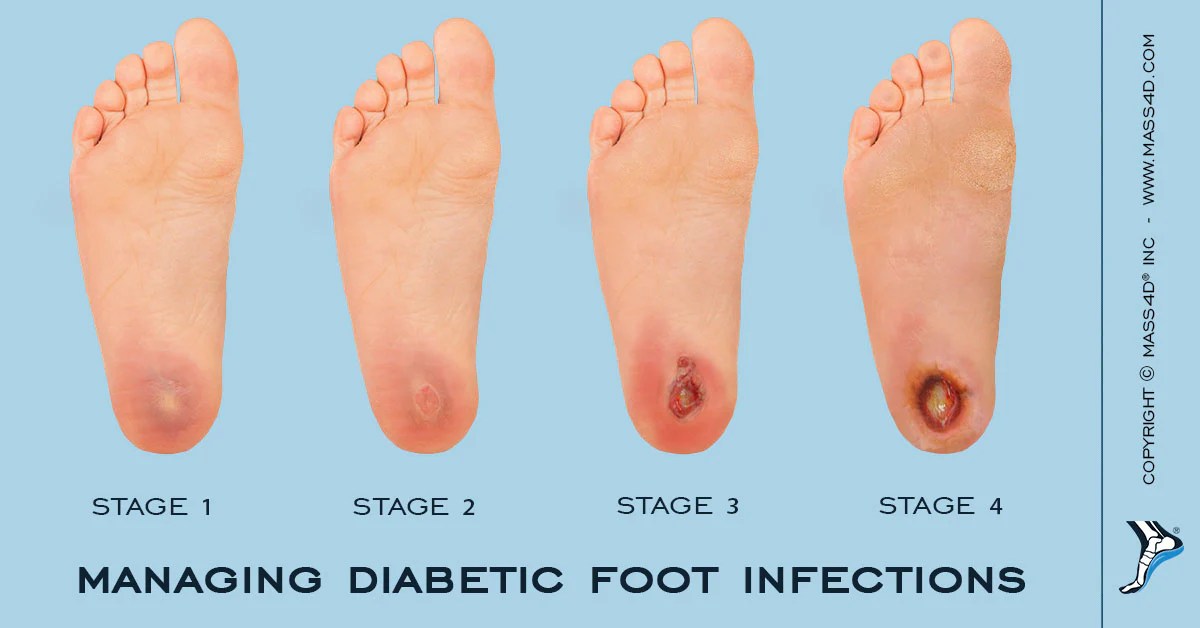 Pengobatan tradisional untuk infeksi jamur pada kaki penderita diabetes