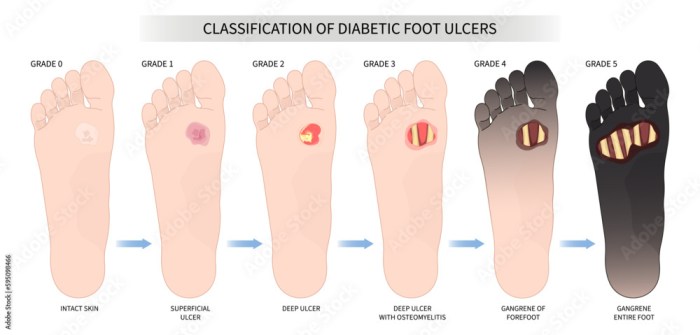 Diabetic ulcers