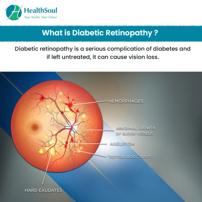 Bagaimana gaya hidup mempengaruhi perkembangan retinopati diabetik?