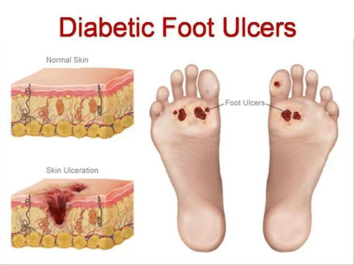 Foot diabetic ulcers ulcer treatment diabetes risk wound symptoms factors people infection care tissue skin glucose managing problems blood health