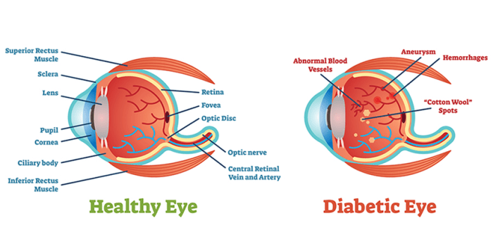 Bagaimana cara mendeteksi dini kerusakan mata karena diabetes?