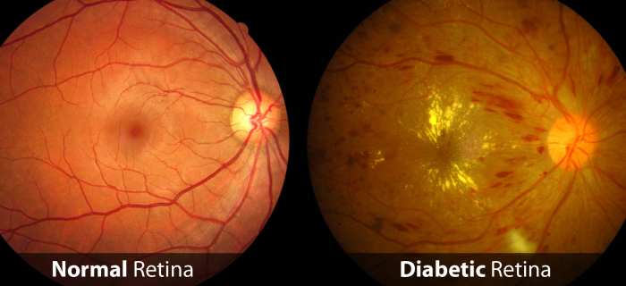 Eye diabetic diabetes disease eyes care types these