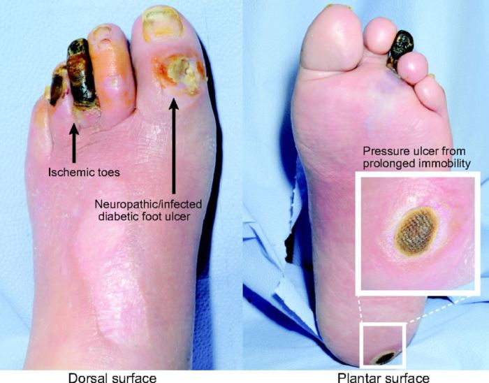 Perbedaan luka kaki hitam diabetes dengan penyakit kulit lainnya