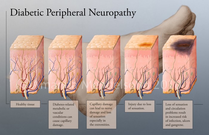 Mengenali tanda awal neuropati perifer pada kaki penderita diabetes