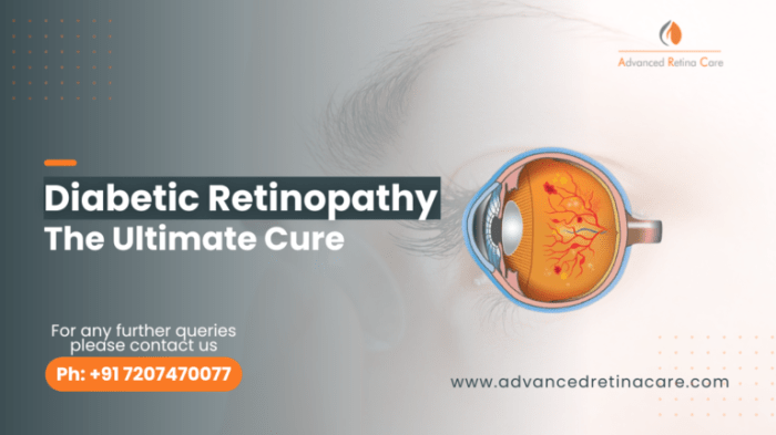 Apakah retinopati diabetik bisa disembuhkan sepenuhnya?