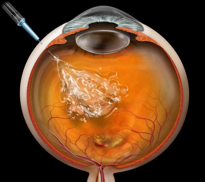 Vegf diabetic retinopathy paradigm retinatoday injections baseline evident compared