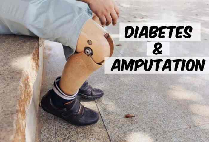 Mencegah amputasi kaki akibat komplikasi diabetes