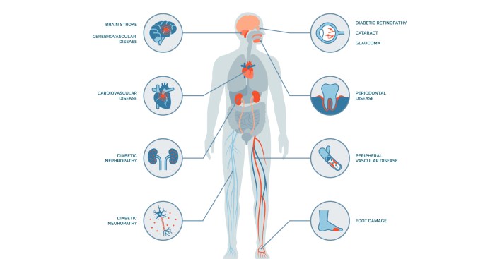 Cara mengatasi komplikasi diabetes melitus tipe 2 jangka panjang