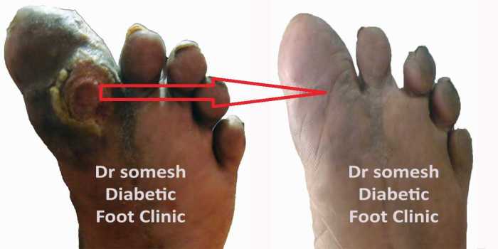 Foot diabetic ulcers ulcer treatment diabetes wound symptoms risk people factors infection care tissue skin