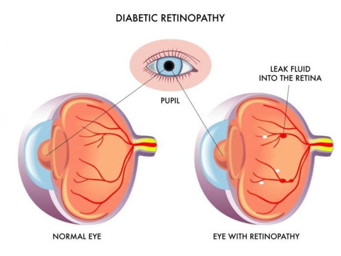 Bagaimana perawatan laser untuk retinopati diabetik dilakukan?