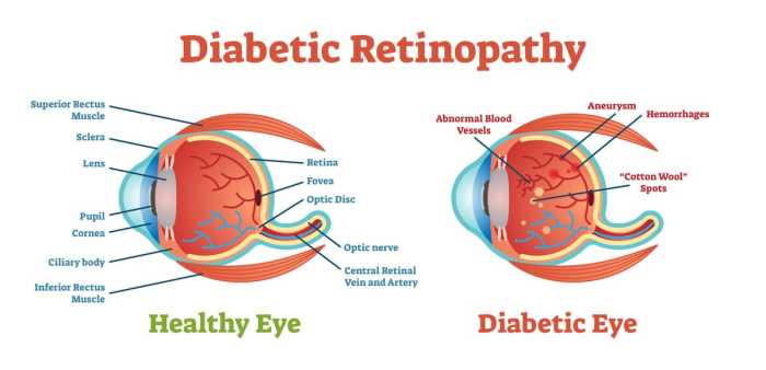 Apa saja gejala awal kerusakan mata akibat diabetes yang perlu diwaspadai?