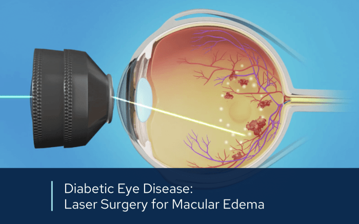 Bagaimana perawatan laser untuk retinopati diabetik dilakukan?