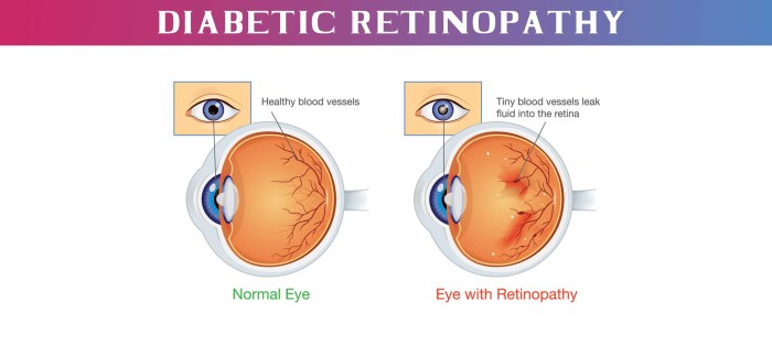 Diabetic eye disease retina normal vision look