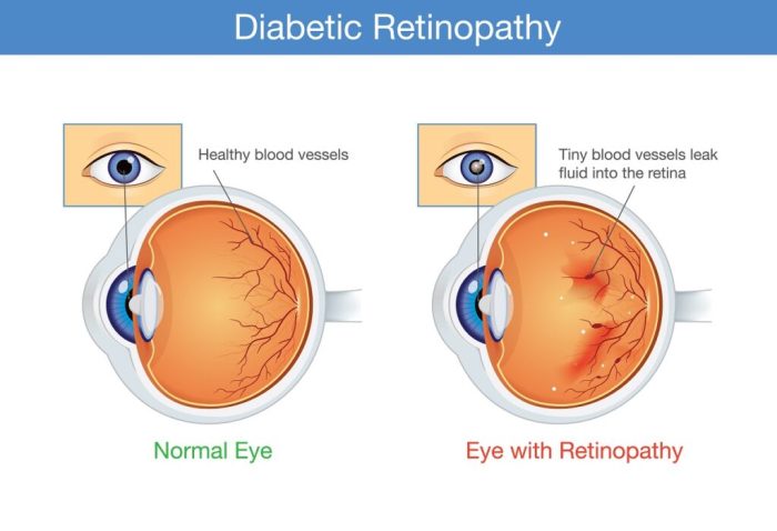 Bagaimana gaya hidup mempengaruhi perkembangan retinopati diabetik?