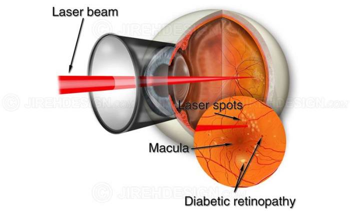 Laser diabetic retinopathy surgery