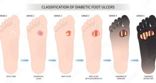 Diabetic ulcers