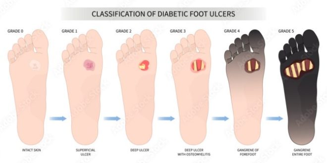 Diabetic ulcers