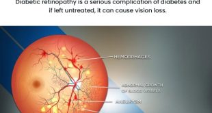 Bagaimana gaya hidup mempengaruhi perkembangan retinopati diabetik?