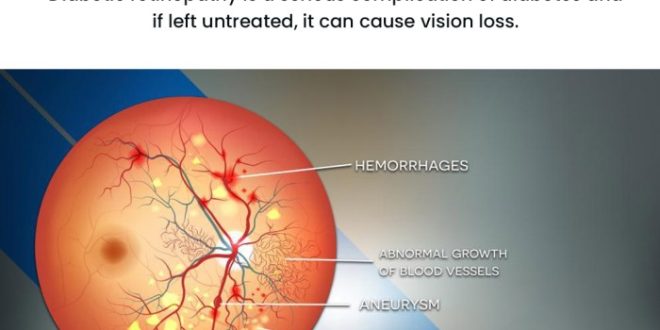 Bagaimana gaya hidup mempengaruhi perkembangan retinopati diabetik?