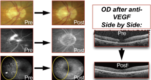 Apakah suntikan anti-VEGF efektif untuk retinopati diabetik?