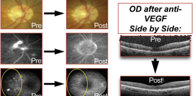 Apakah suntikan anti-VEGF efektif untuk retinopati diabetik?