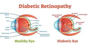 Apa saja gejala awal kerusakan mata akibat diabetes yang perlu diwaspadai?