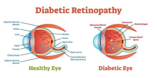 Apa saja gejala awal kerusakan mata akibat diabetes yang perlu diwaspadai?