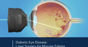 Bagaimana perawatan laser untuk retinopati diabetik dilakukan?