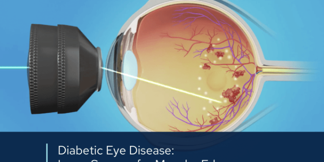 Bagaimana perawatan laser untuk retinopati diabetik dilakukan?